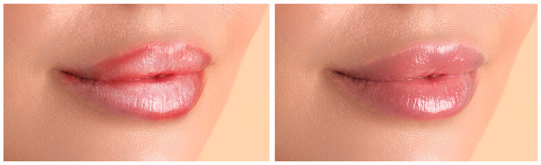 Fototapeta premium Lip care. Woman with chapped and dry skin before and healthy skin after moisturizing treatment, collage