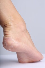 Woman with dry skin on her foot against light background, closeup
