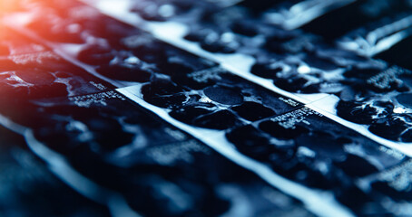 Mri scan of spine showing disc protrusion in detail