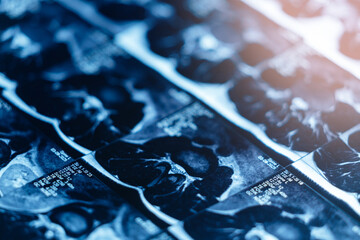 Mri scan of spinal protrusion in detailed medical imaging