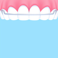 Upper teeth (Hawley retainer) - Text box banner (square) illustration vector design. Dental care concept.