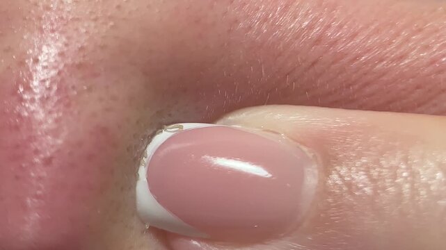 Macro video of blackhead removal on nose. Finger pressure pushes out clogged sebum and oil. Realistic skincare extraction content for cosmetic, dermatology or health projects.