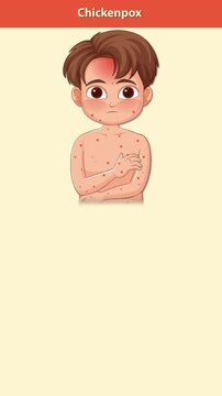 Chickenpox Symptoms Progression in Young Boy Animation Sequence