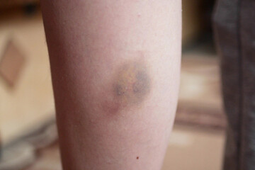 Fototapeta premium Closeup of hands applying balm to leg. Knee injury, skin hematoma, skin repair concept. slow motion