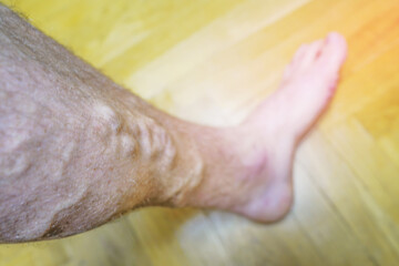 Varicose veins. Phlebology and DVT. Varicose veins on leg of man. Varicosity on legs, spider veins, edema, health illness concept. Phlebeurysm and thrombophlebitis of veins. Phlebology concept.