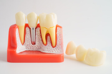 Dental implant, artificial tooth roots into jaw.