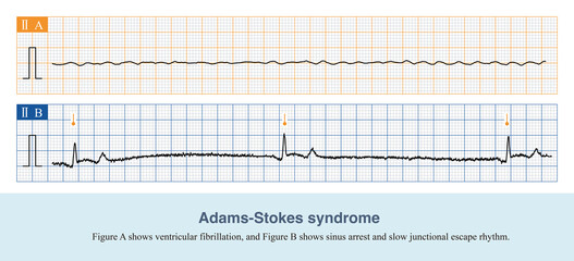 When malignant arrhythmias cause a sudden decrease in cardiac output, the patient will experience symptoms such as amaurosis, syncope, and convulsions, which is called Adams-Stokes syndrome.
