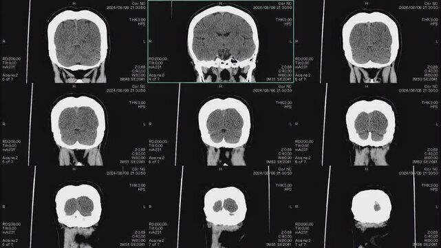 Magnetic resonance images of the head, MRI of the brain, front and top viev of a patient with multiple vascular infarctions,1 image and 3x3 grid, color animation Seamless Loop