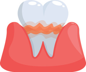 Dental illustration showing tartar buildup causing gingivitis and periodontitis, highlighting the importance of oral hygiene
