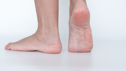 Fototapeta premium Close-up view of human feet showing corns and calluses, highlighting skin texture and foot health concerns in a clinical setting