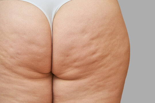 Close-up of female adult caucasian skin with visible cellulite on thighs from rear view.