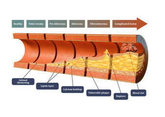 Coronary atherosclerosis timeline