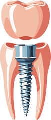 Realistic medical illustration of a dental implant showing a titanium screw integrated into the tooth root structure, used for educational and dental care materials.
