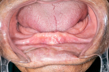An elder dentistry patient case open mouth, lips retracted with a plastic cheek retractor. Close up front view showing an edentulous and atrophied anterior mandibular arch.