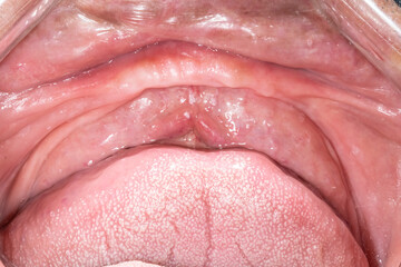 An elder dentistry patient case open mouth, lips retracted with a plastic cheek retractor. Close up overhead view showing an edentulous and atrophied anterior mandibular arch.