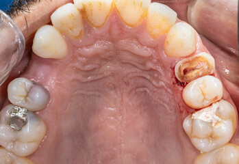 Close-up intraoral view of maxillary arch showing a premolar crown destroyed with visible root canals, a molar filled with temporary cement, and one restored with a metallic alloy amalgam filling