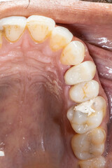 Intraoral close-up of maxillary arch showing first premolar restored with prosthodontic crown and adjacent molar filled with temporary cement material.