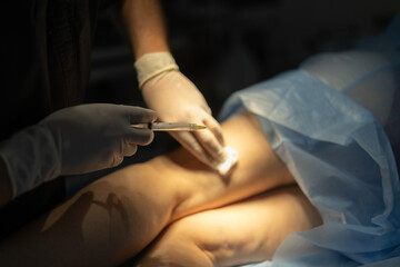 Close-up of sclerotherapy injection for varicose veins performed by vascular surgeon in clinic.