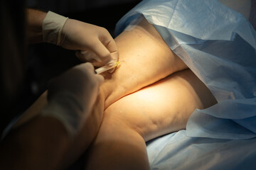 Doctor performing sclerotherapy procedure with syringe, treating varicose veins on patient’s leg. Medical treatment concept.