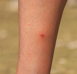 A leg with a red mark on it
