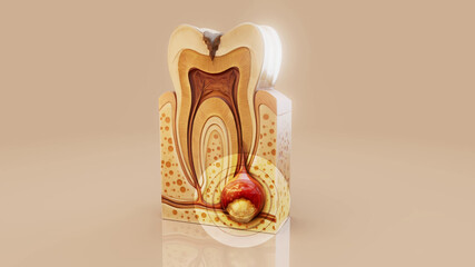 Conceptual 3D illustration of a dental abscess with pus and infection