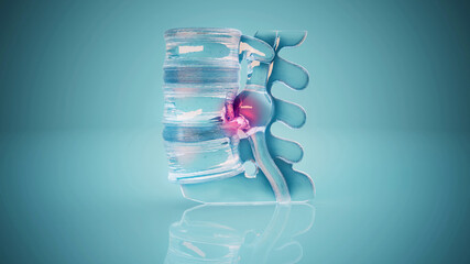 Conceptual 3D illustration of a herniated disk in the lumbar spine
