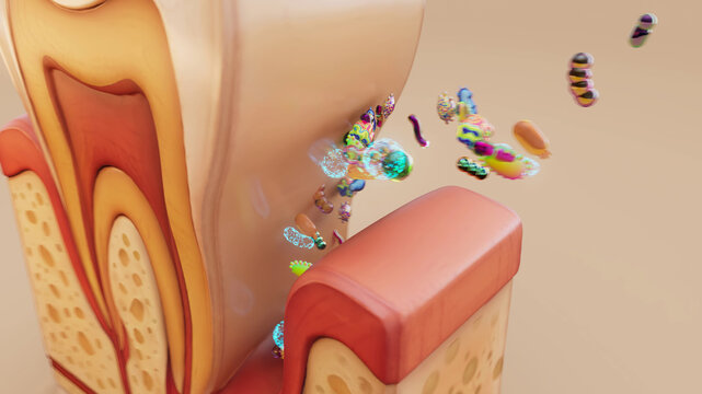 Conceptual 3D illustration of periodontitis with bacteria under the gums
