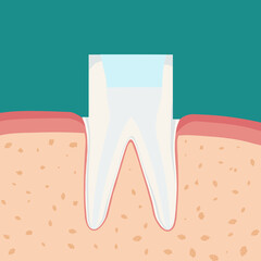 치아 신경치료와 충치치료 tooth root canal treatment