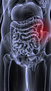 3D medical animation of an inguinal hernia with intestine protruding