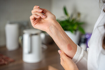 Scald burn on a hand caused by steam from a kettle in a kitchen. Domestic accident illustrating the danger of hot appliances.