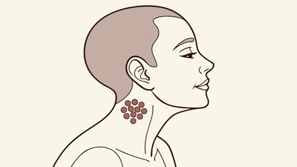 Illustration of a persons neck with a cluster of circular marks medical diagram healthcare dermatology skin condition symptom vector art.