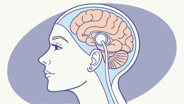 Medical illustration brain anatomy cerebrospinal fluid shunt healthcare neurological neurosurgery medical device health medicine science biology human body human head profile view s.
