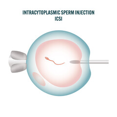 Intracytoplasmic sperm injection ICSI procedure illustration — medical fertilization process showing sperm injected into egg cell, IVF and assisted reproductive technology educational diagram biology