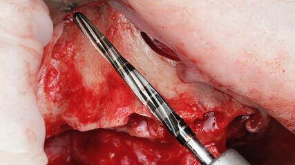 long dental drill for upper jaw implantation © Dental Pro Content