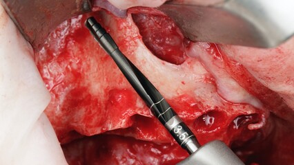 An unusual black dental drill for upper jaw implantation