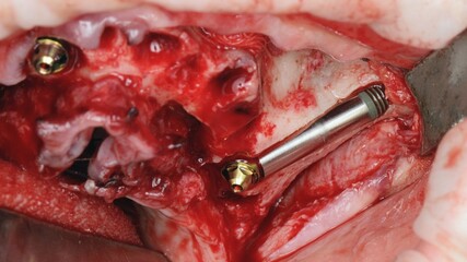 a dental implant installed in the zygomatic bone of the upper jaw © Dental Pro Content