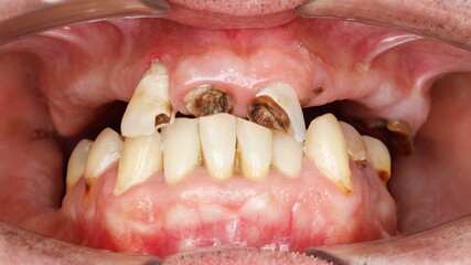 edentulous upper jaw of a patient before implantation