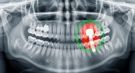Panoramic dental xray showing jaw with dental implant highlighted in red and green, indicating problem area or treatment focus