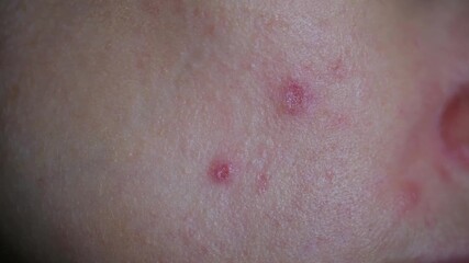 Close up view woman applying medicated cream with cotton pad to treat red pimples and blemishes on their facial skin, illustrating daily skincare and dermatology routine. Acne pimples on face woman - Powered by Adobe