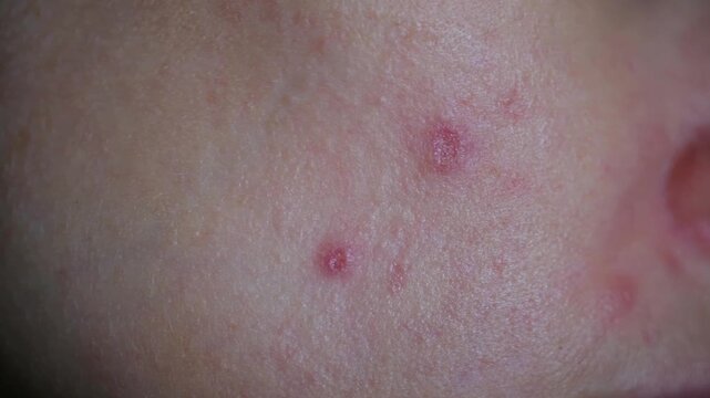 Close up view woman applying medicated cream with cotton pad to treat red pimples and blemishes on their facial skin, illustrating daily skincare and dermatology routine. Acne pimples on face woman