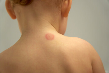 View of a child shoulder displaying a mosquito bite that has caused noticeable redness and irritation