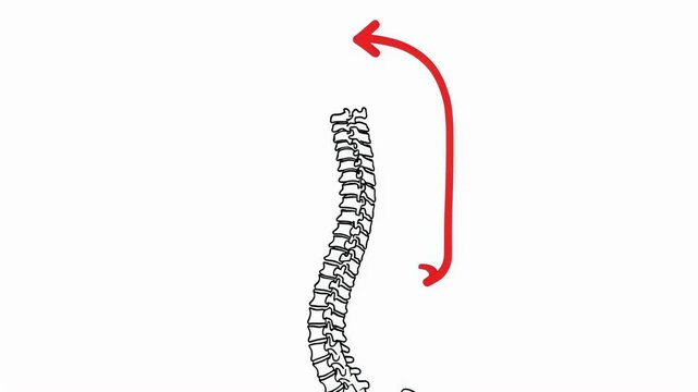 Three sequential frames showing a human spine with scoliosis and red arrow pointing to curve. Back pain, science, medical education footage.