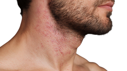 PNG of Close-up of a Caucasian male's neck with visible skin irritation and beard, showcasing texture and condition.