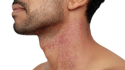 Fototapeta premium PNG of Close-up of a male with a skin condition on the neck, showing visible redness and vascular markings.