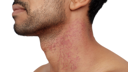 PNG of Close-up of a male with a skin condition on the neck, showing visible redness and vascular markings.