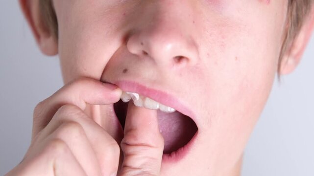 A teenage boy demonstrates and removes clear mouth guards and aligners for teeth straightening.