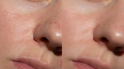 Side-by-side comparison of female skin texture showing pores and redness before and after treatment. Ideal for skincare, cosmetic results, dermatology or advertising.
