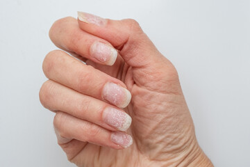 Damaged fingernails after gel polish removal. A natural hand with problematic cuticles and broken nails. Emotional stress. Age-related skin changes. Concept of nail care Hand care.