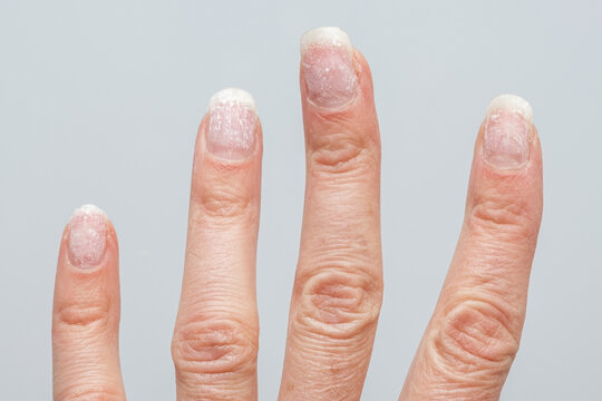 Damaged fingernails with white patches and dry cuticles on fingers close-up. A hand with problematic cuticles and broken nails. Emotional stress. Age-related skin changes. Hand care.