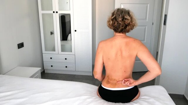 A woman with a large bruise on her back sits on a bed in hospital, indoors
